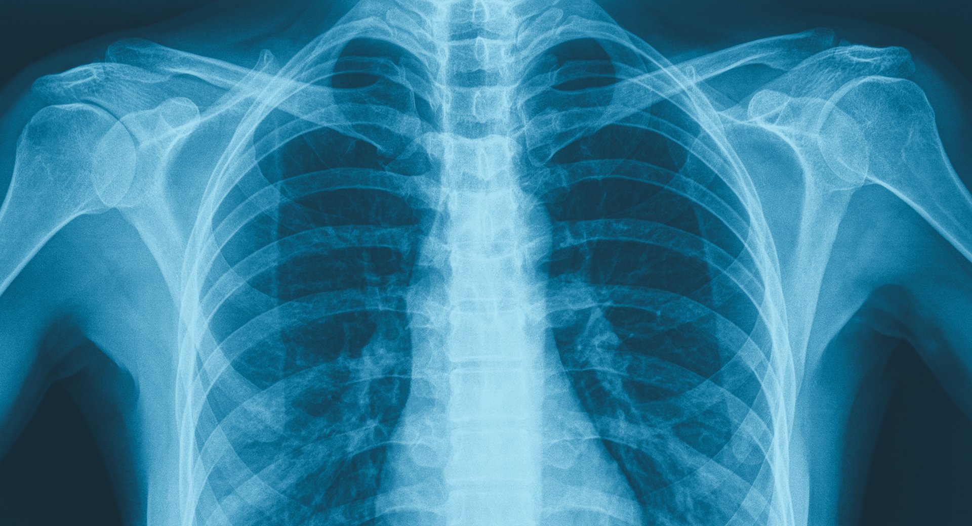 LSX - Chest X-Ray Header