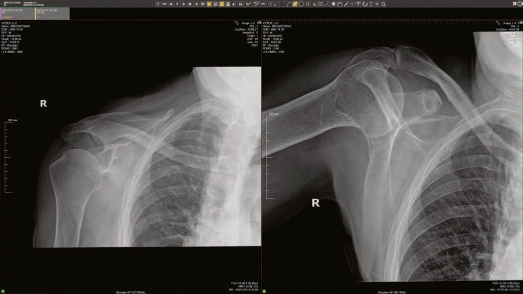 mKDR xpress Shoulder IMAGE